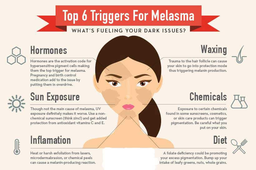 melasma Bangladesh